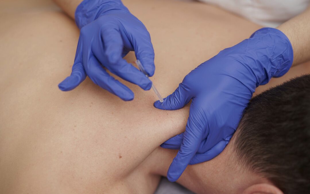 Unlocking Mobility: The Remarkable Benefits of Dry Needling in Physiotherapy